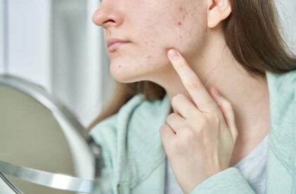 difference between adult and teen acne