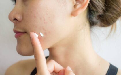 The side profile of a woman with dark hair pulled into a bun. She applies a dot of cream to her cheek to treat red blemishes.