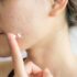 6 Daily Bad Habits That Are Causing Acne
